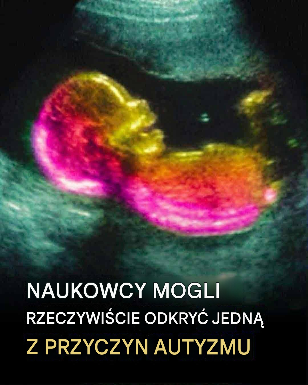 Naukowcy mogli faktycznie odkryć jedną z przyczyn autyzmu