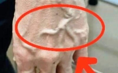 Dlaczego Twoje żyły nagle stają się widoczne i nabrzmiałe?