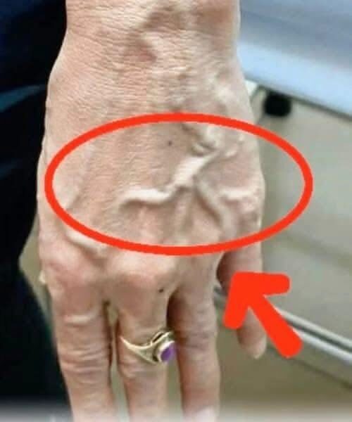 Dlaczego Twoje żyły nagle stają się widoczne i nabrzmiałe?