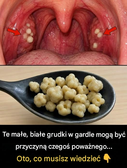 Te małe białe grudki w gardle: czym są kamienie migdałkowe i jak się ich pozbyć