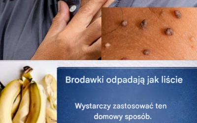 Skórka banana i inne naturalne składniki do leczenia brodawek