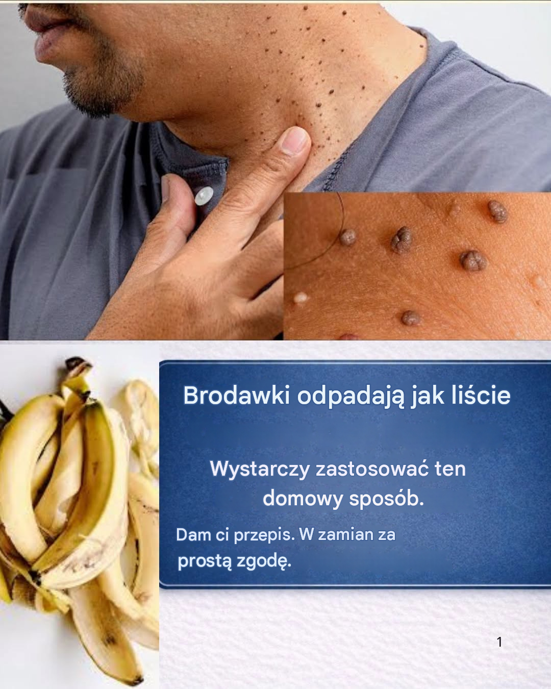 Skórka banana i inne naturalne składniki do leczenia brodawek