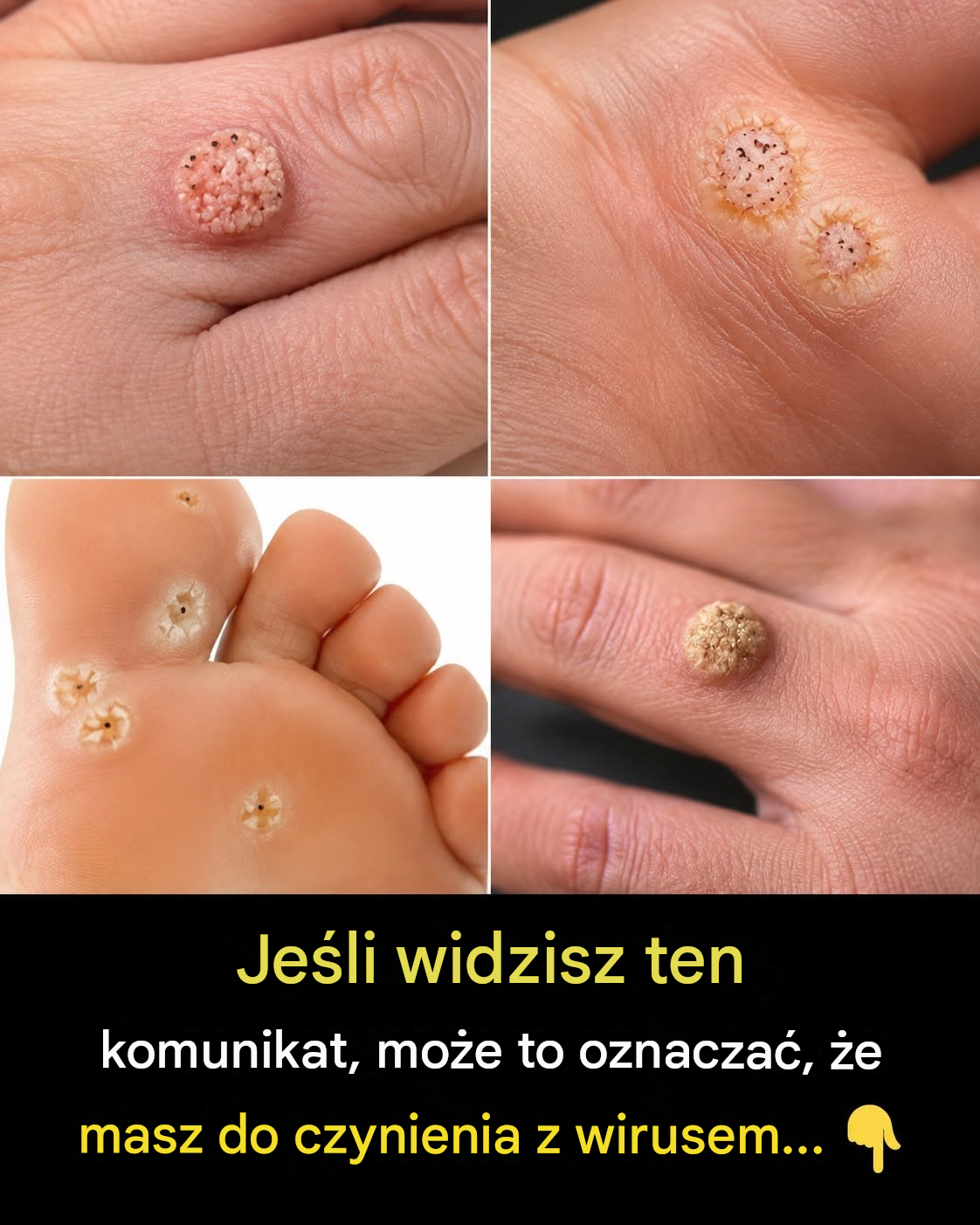 6 rodzajów brodawek (objawy, symptomy, domowe sposoby leczenia i leczenie)