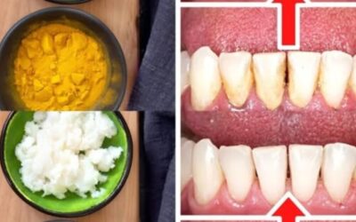 Jak usunąć kamień nazębny i płytkę nazębną bez wizyty u dentysty: kurkuma i sól