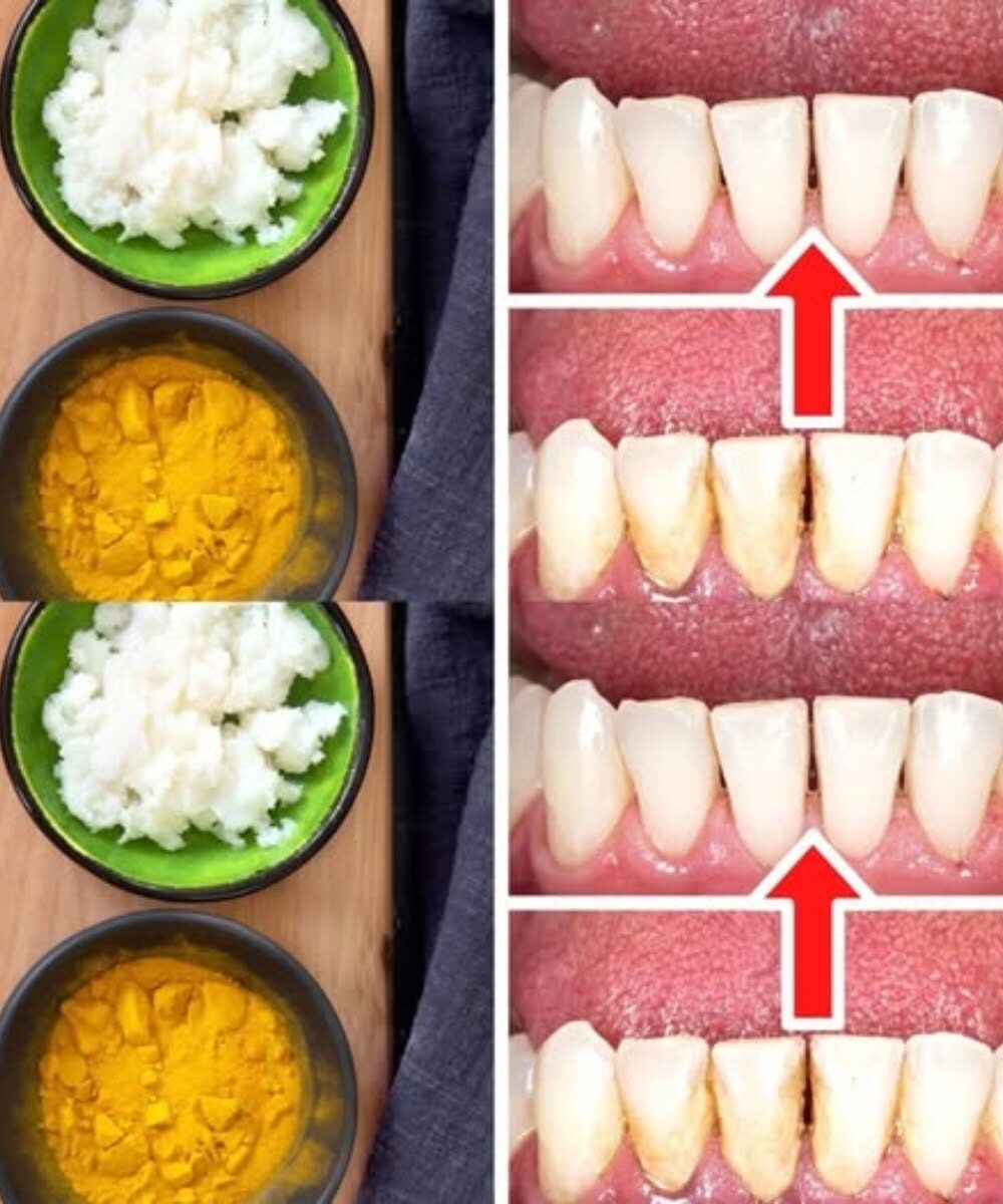 Jak usunąć kamień nazębny i płytkę nazębną bez wizyty u dentysty: kurkuma i sól
