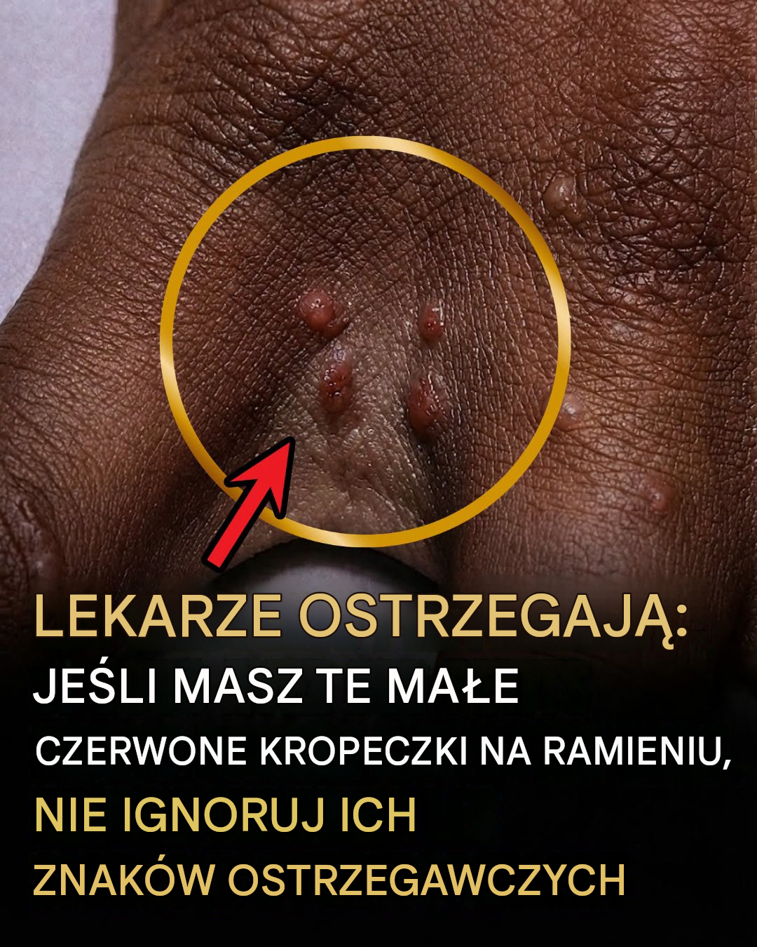 Jeśli zauważysz te bolesne, czerwone grudki, może to oznaczać, że cierpisz na wyprysk dyshydrotyczny.