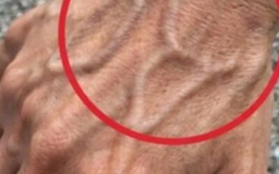 Kiedy należy się martwić o nagle widoczne żyły
