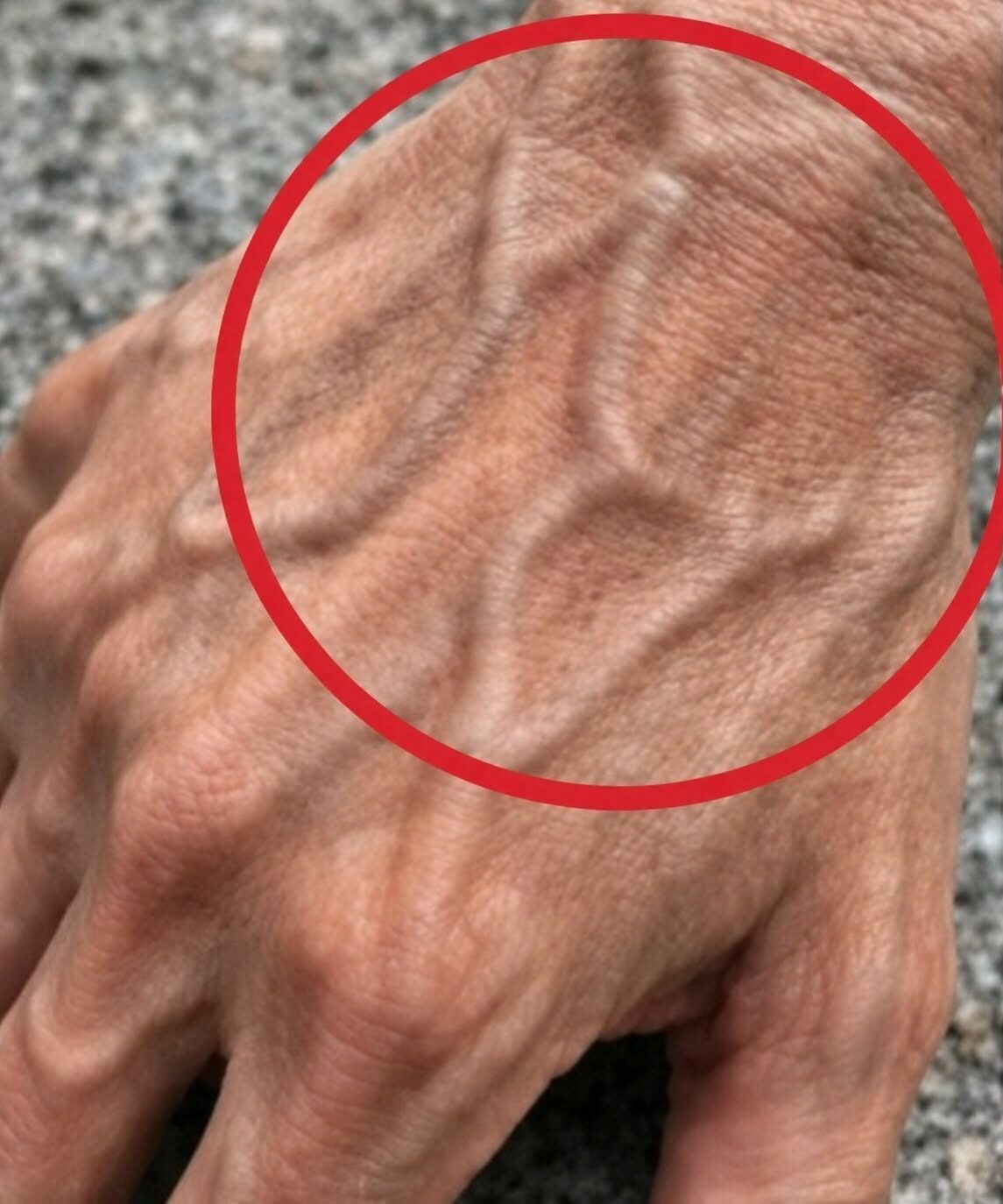 Jeżeli masz widoczne żyły, oznacza to, że jesteś...