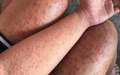 Delikatny, poparty naukowo przewodnik po rozpoznawaniu i reagowaniu na ciężkie reakcje alergiczne