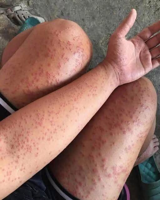 Delikatny, poparty naukowo przewodnik po rozpoznawaniu i reagowaniu na ciężkie reakcje alergiczne
