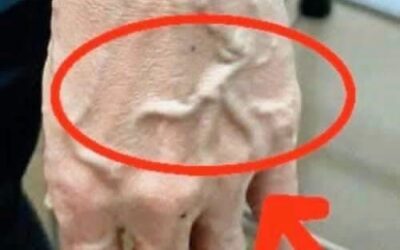 Dlaczego Twoje żyły nagle stają się widoczne i nabrzmiałe?