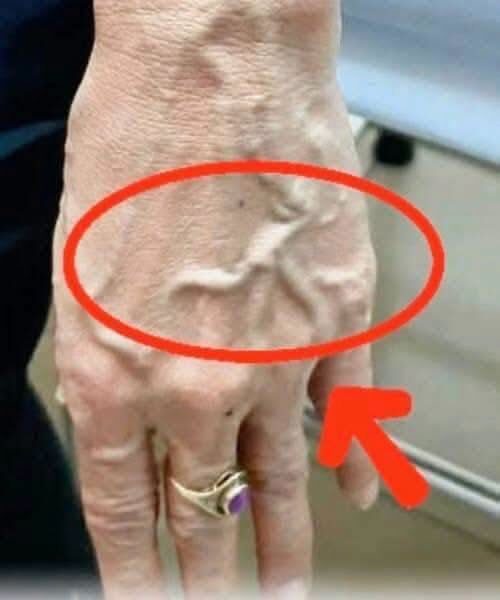Dlaczego Twoje żyły nagle stają się widoczne i nabrzmiałe?