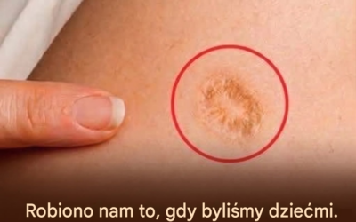 Dla wielu osób mała, okrągła blizna na ramieniu stanowi trwałe przypomnienie monumentalnego triumfu w dziedzinie zdrowia publicznego. Blizna po szczepionce przeciw ospie to coś więcej niż tylko skaza; to ikoniczne świadectwo jednego z najważniejszych punktów zwrotnych w historii medycyny i niezwykłego naturalnego procesu gojenia się ludzkiej skóry. W epoce powszechnych szczepień, ten wyraźny ślad funkcjonował nawet jako oficjalny dowód odporności, często sprawdzany podczas badań przesiewowych w miejscach takich jak Ellis Island. Chociaż ospa prawdziwa została uznana za eradykowaną w Stanach Zjednoczonych w latach pięćdziesiątych XX wieku i usunięta z rutynowych szczepień dzieci na początku lat siedemdziesiątych XX wieku, dziedzictwo tej szczepionki pozostaje wyryte w skórze milionów ludzi. Powstanie tego unikalnego znaku jest bezpośrednio związane ze specyficzną metodą podania szczepionki. W przeciwieństwie do współczesnych zastrzyków, do których używa się standardowej igły podskórnej, szczepionka przeciwko ospie prawdziwej zawierała żywego wirusa ospy prawdziwej (vaccinia), który jest spokrewniony z wirusem ospy prawdziwej, ale znacznie mniej niebezpieczny niż on sam. Pracownicy służby zdrowia podawali szczepionkę za pomocą rozwidlonej igły, którą zanurzano w roztworze szczepionki, a następnie używano do wykonywania wielu drobnych nakłuć w powierzchniowej warstwie skóry, zwanej skórą właściwą. To celowe, kontrolowane uszkodzenie miało na celu pobudzenie układu odpornościowego do produkcji przeciwciał ochronnych. Gdy wirus wniknie do skóry właściwej,...