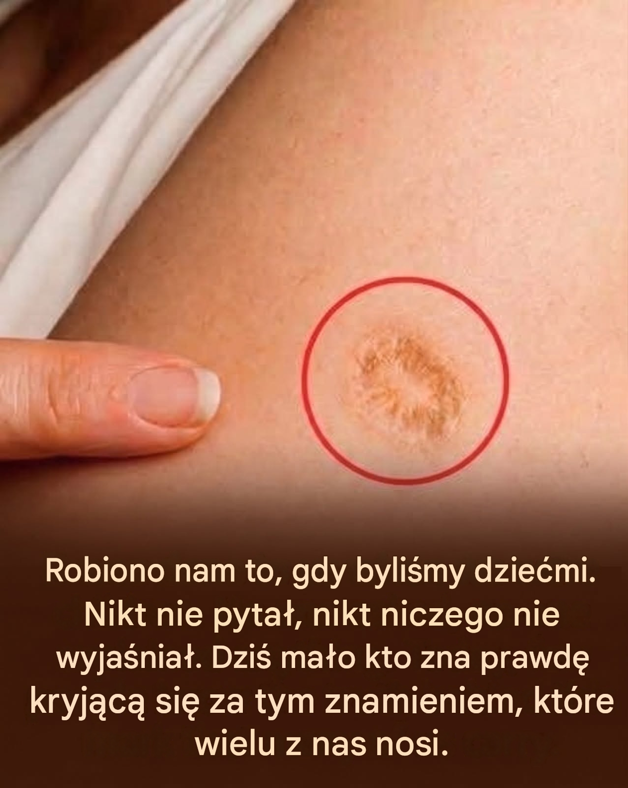Dla wielu osób mała, okrągła blizna na ramieniu stanowi trwałe przypomnienie monumentalnego triumfu w dziedzinie zdrowia publicznego. Blizna po szczepionce przeciw ospie to coś więcej niż tylko skaza; to ikoniczne świadectwo jednego z najważniejszych punktów zwrotnych w historii medycyny i niezwykłego naturalnego procesu gojenia się ludzkiej skóry. W epoce powszechnych szczepień, ten wyraźny ślad funkcjonował nawet jako oficjalny dowód odporności, często sprawdzany podczas badań przesiewowych w miejscach takich jak Ellis Island. Chociaż ospa prawdziwa została uznana za eradykowaną w Stanach Zjednoczonych w latach pięćdziesiątych XX wieku i usunięta z rutynowych szczepień dzieci na początku lat siedemdziesiątych XX wieku, dziedzictwo tej szczepionki pozostaje wyryte w skórze milionów ludzi. Powstanie tego unikalnego znaku jest bezpośrednio związane ze specyficzną metodą podania szczepionki. W przeciwieństwie do współczesnych zastrzyków, do których używa się standardowej igły podskórnej, szczepionka przeciwko ospie prawdziwej zawierała żywego wirusa ospy prawdziwej (vaccinia), który jest spokrewniony z wirusem ospy prawdziwej, ale znacznie mniej niebezpieczny niż on sam. Pracownicy służby zdrowia podawali szczepionkę za pomocą rozwidlonej igły, którą zanurzano w roztworze szczepionki, a następnie używano do wykonywania wielu drobnych nakłuć w powierzchniowej warstwie skóry, zwanej skórą właściwą. To celowe, kontrolowane uszkodzenie miało na celu pobudzenie układu odpornościowego do produkcji przeciwciał ochronnych. Gdy wirus wniknie do skóry właściwej,...