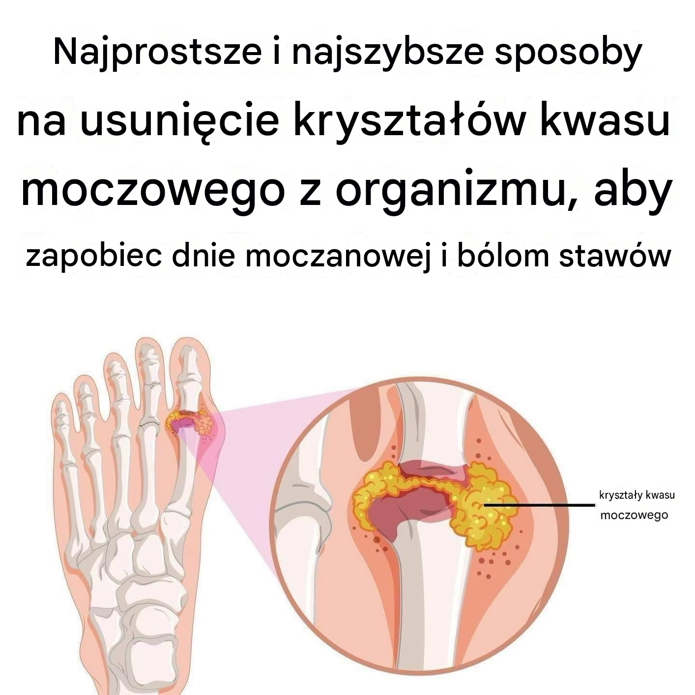 Jak naturalnie złagodzić dnę moczanową i ból stawów
