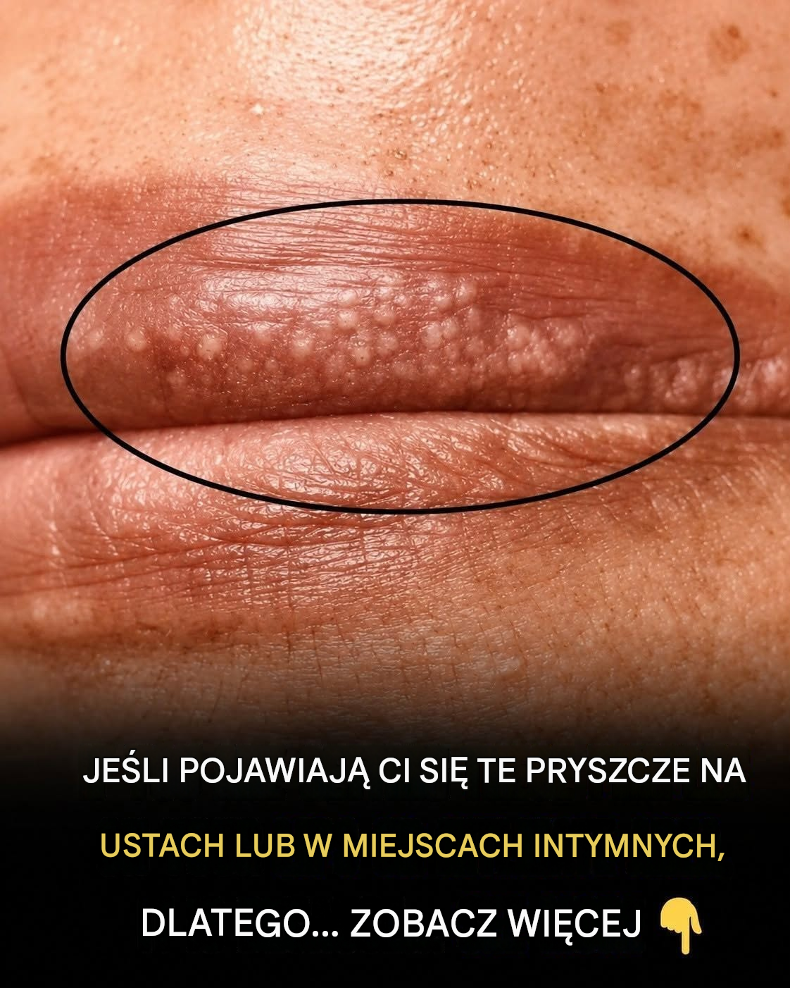 Jeśli na ustach lub w okolicach intymnych pojawiają się białe pryszcze, oto co mogą one oznaczać