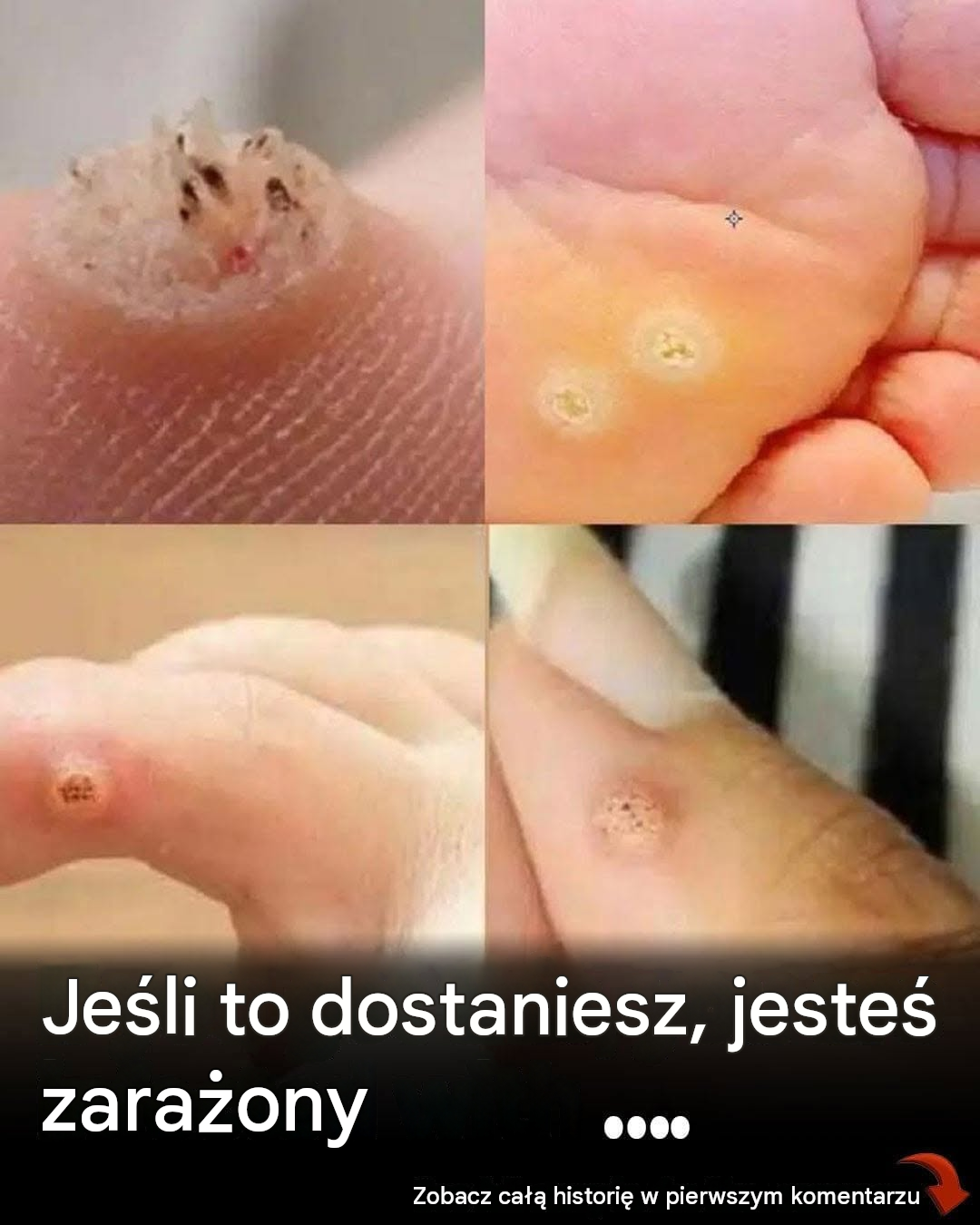 6 rodzajów brodawek (objawy, symptomy, domowe sposoby leczenia i leczenie)