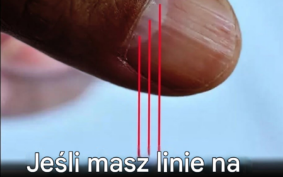 Linie na paznokciach mogą świadczyć o niedoborach żywieniowych lub innych problemach zdrowotnych