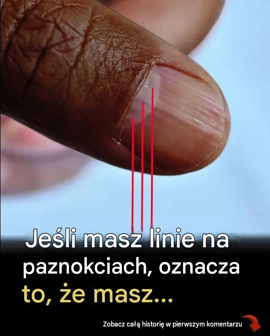 Linie na paznokciach mogą świadczyć o niedoborach żywieniowych lub innych problemach zdrowotnych