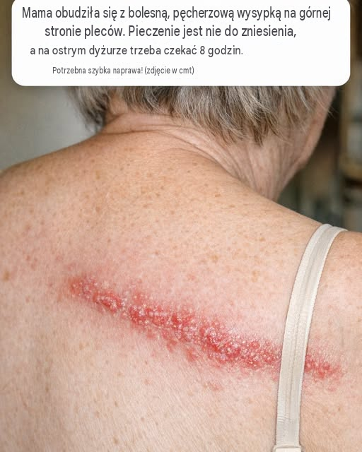 Mama obudziła się z bolesną, pęcherzową wysypką na górnej stronie pleców. Pieczenie jest nie do zniesienia, a na pogotowiu czeka się 8 godzin. Potrzebuję szybkiej pomocy!