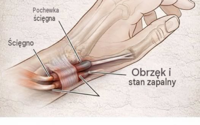Dlaczego drętwieją Ci ręce i co możesz z tym zrobić (2)