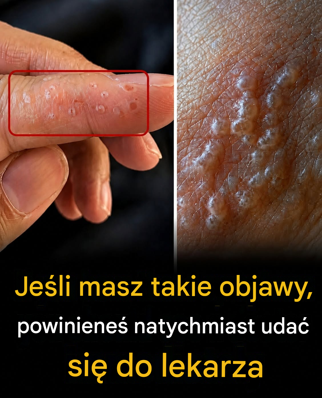 Malutkie pęcherze na palcach? Tych objawów nigdy nie należy ignorować