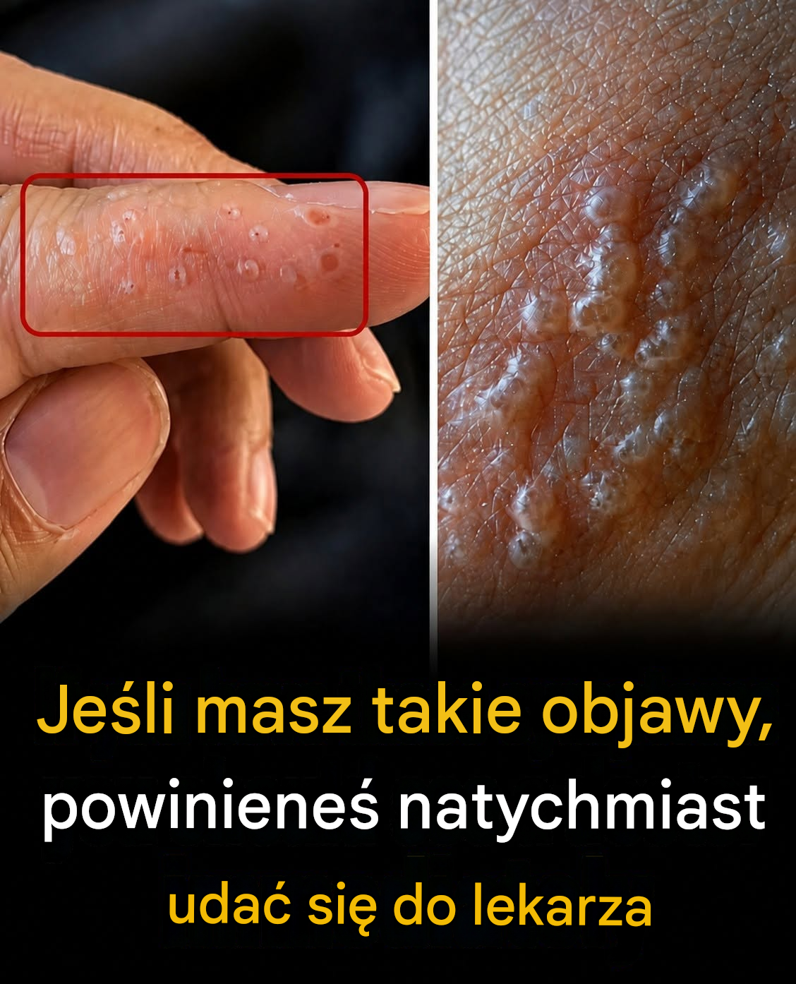 Malutkie pęcherze na palcach? Tych objawów nigdy nie należy ignorować