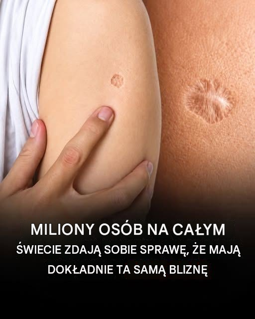 Dlaczego tak wiele osób ma tę samą małą bliznę? Tajemnica globalnego znamienia