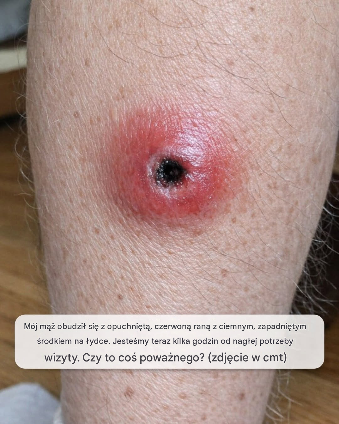 Mój mąż obudził się z opuchniętą, czerwoną raną z ciemnym, zapadniętym środkiem na łydce. Jesteśmy teraz kilka godzin od nagłej potrzeby. Czy to coś poważnego?