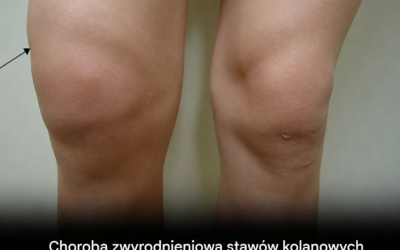 Ból czy sztywność kolana? Te 5 objawów może wskazywać na chorobę zwyrodnieniową stawów