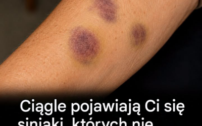 Niewyjaśnione siniaki na ciele: przyczyny i leczenie