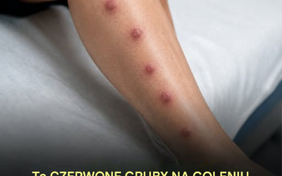 Bolesne, przypominające siniaki guzki na piszczelach? Co może oznaczać rumień guzowaty?