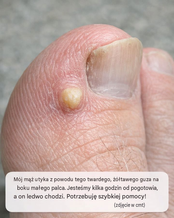 Mój mąż utyka z powodu tego twardego, żółtawego guza na boku małego palca. Jesteśmy kilka godzin od pogotowia, a on ledwo chodzi. Potrzebuję szybkiej pomocy!