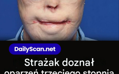 Strażak doznał oparzeń trzeciego stopnia – to on 11 lat później
