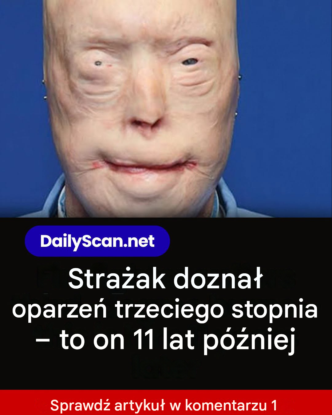 Strażak doznał oparzeń trzeciego stopnia – to on 11 lat później