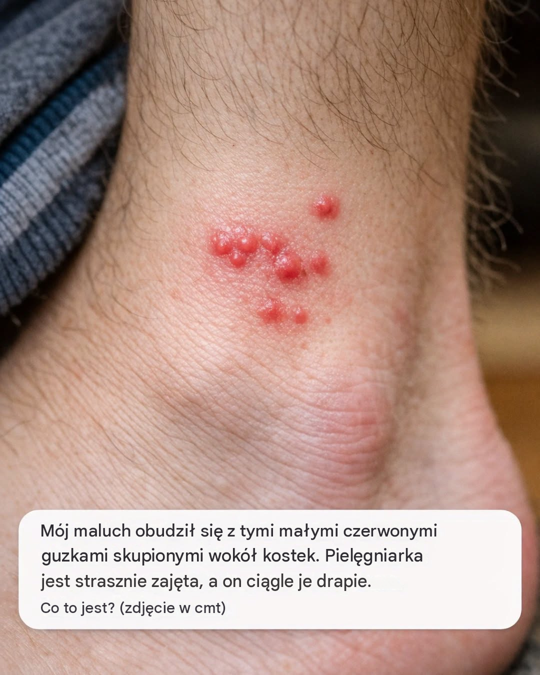 Mój maluch obudził się z tymi małymi czerwonymi guzkami skupionymi wokół kostek. Pielęgniarka jest strasznie zajęta, a on ciągle je drapie. Co to jest?