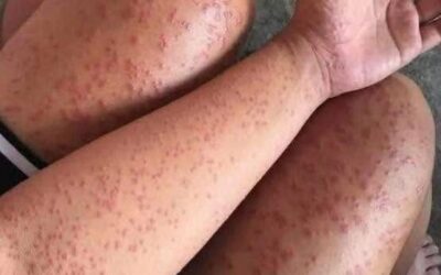 Całe ciało go swędziało i myślał, że to tylko alergia...