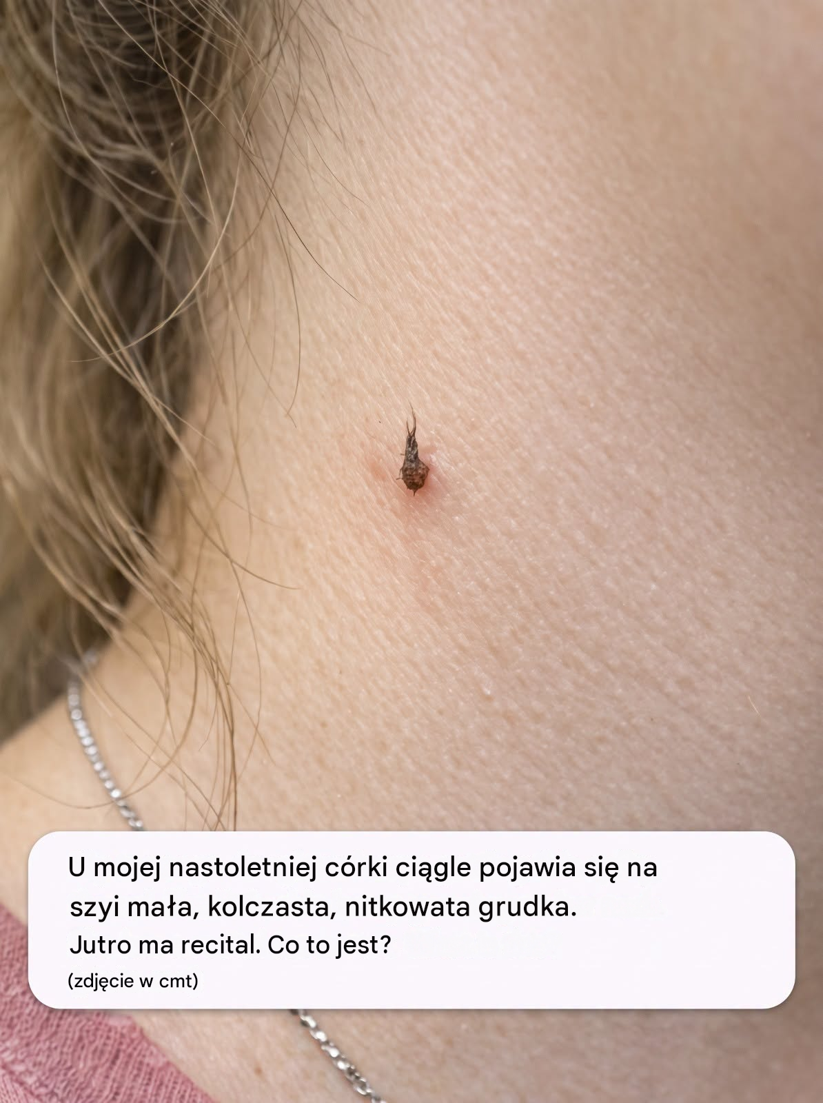 Mojej nastoletniej córce ciągle wyrasta na szyi ten kolczasty, nitkowaty guzek. Jutro ma recital. Co to jest?