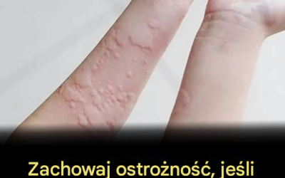 8 zaskakujących czynników wywołujących pokrzywkę, które możesz przeoczyć