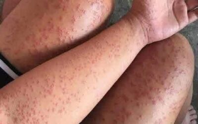 Wysypka skórna z problemami z oddychaniem? To może być zagrażająca życiu reakcja alergiczna.