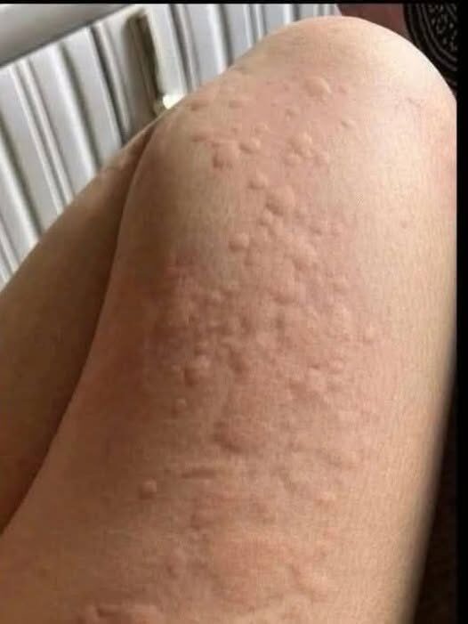 Myślał, że to tylko alergia — ale prawdziwa przyczyna zmieniła wszystko