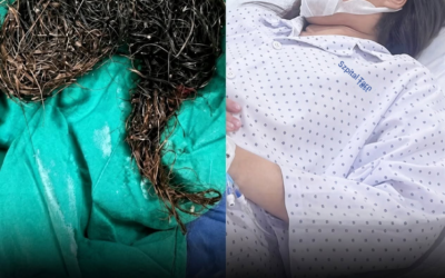 14-letnia dziewczynka cierpiała na bóle brzucha przez miesiące – co odkryli lekarze