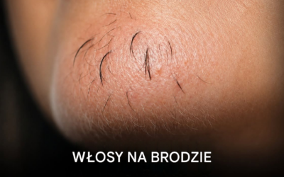Eksperci twierdzą, że owłosienie na brodzie u kobiety może być oznaką czegoś więcej niż tylko starzenia się