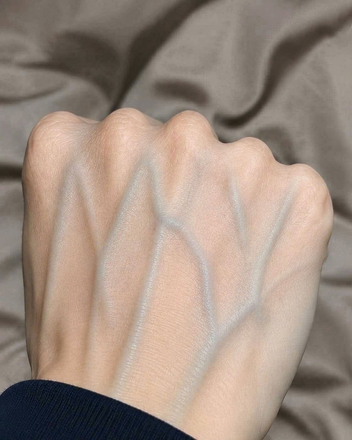 Dlaczego żyły na dłoniach nagle stają się bardziej widoczne ? Lekarze wyjaśniają , co może Ci mówić Twoje ciało Czy kiedykolwiek spojrzałeś na swoje dłonie i zauważyłeś , że żyły wydają się większe , ciemniejsze lub bardziej widoczne niż kiedyś ? Być może wyglądają jak wypukłe niebieskie linie na grzbietach dłoni , a może stają się szczególnie widoczne po ćwiczeniach fizycznych , przebywaniu w ciepłej pogodzie lub gorącym prysznicu . U wielu osób ta nieoczekiwana zmiana natychmiast rodzi pytanie : Czy widoczne żyły mogą być oznaką jakiegoś ukrytego problemu zdrowotnego? To zrozumiały problem . Nasze dłonie należą do najbardziej widocznych części ciała i nawet subtelne zmiany w ich wyglądzie mogą przyciągać uwagę . W przeciwieństwie do zmian zachodzących pod ubraniem , widocznych żył na dłoniach trudno nie zauważyć . Media społecznościowe jeszcze bardziej rozpowszechniły ten problem . Posty sugerują czasami , że wybrzuszone żyły na dłoniach świadczą o zablokowanych tętnicach, chorobach serca , niebezpiecznych zakrzepach krwi lub zaburzeniach krążenia. Chociaż niektóre schorzenia naczyniowe mogą wpływać na wygląd żył , te alarmujące doniesienia często pomijają fundamentalny fakt medyczny : widoczne żyły na dłoniach są niezwykle powszechne i w większości przypadków nieszkodliwe. Na ich wygląd mogą wpływać czynniki takie jak starzenie się, genetyka, grubość skóry , tkanka tłuszczowa , aktywność fizyczna , temperatura i codzienne zmiany w przepływie krwi . Niektórzy ludzie naturalnie mają widoczne żyły przez całe życie , podczas gdy inni zauważają , że stają się one bardziej widoczne z wiekiem . Jednak nie każdą zmianę należy ignorować . Żyła , która nagle staje się bolesna, opuchnięta, nietypowo twarda lub otoczona przebarwioną skórą , może wymagać konsultacji lekarskiej . Ważne jest nie tylko to , czy żyły są widoczne, ale także to , czy zmienił się ich wygląd i czy występują inne objawy . Zrozumienie przyczyn, dla których żyły na dłoniach stają się widoczne , może pomóc w rozpoznawaniu normalnych zmian w organizmie , a jednocześnie w zwracaniu uwagi na objawy , które zasługują na uwagę. 1. Zrozumienie żył pod skórą Zanim przejdziemy do wyjaśnienia , dlaczego żyły na dłoniach stają się bardziej widoczne, warto zrozumieć ich rolę w układzie krążenia . Twój organizm zawiera rozległą sieć naczyń krwionośnych , które odpowiadają za transport krwi pomiędzy sercem , płucami i tkankami. Tętnice odprowadzają krew z serca , a żyły ją do niego odprowadzają . Większość tętnic transportuje krew bogatą w tlen , a większość żył transportuje krew , która już dostarczyła znaczną ilość tlenu do tkanek organizmu . Żyły w Twoich rękach nieustannie wykonują tę ważną pracę . Niektóre żyły znajdują się głęboko w mięśniach i tkankach , podczas gdy inne leżą znacznie bliżej powierzchni skóry . Nazywa się je żyłami powierzchownymi . Żyły powierzchowne są szczególnie widoczne na grzbietach dłoni , ponieważ jest tam stosunkowo niewiele tkanki oddzielającej je od świata zewnętrznego . Ich niebieski lub zielonkawy wygląd jest częściowo efektem optycznym związanym ze sposobem, w jaki światło oddziałuje na skórę i znajdujące się pod nią naczynia krwionośne . Krew w ich wnętrzu tak naprawdę nie jest niebieska. U wielu osób żyły powierzchowne tworzą rozgałęzioną sieć , biegnącą od palców w kierunku nadgarstka . Ich wzór różni się u poszczególnych osób , podobnie jak odciski palców. Wygląd tych żył może się także zmieniać w ciągu dnia . Kiedy dłonie zwisają poniżej poziomu serca , w żyłach powierzchownych może chwilowo gromadzić się więcej krwi , przez co wydają się one pełniejsze. Uniesienie dłoni może czasami sprawić , że będą mniej widoczne . Ta normalna reakcja na grawitację pokazuje, dlaczego sama widoczność żył nie jest wystarczającym dowodem na to, że ktoś cierpi na chorobę układu krążenia . Żyła może być wyraźnie widoczna nawet podczas normalnego funkcjonowania . Znaczenie medyczne zależy od ogólnego wzorca , historii zdrowia danej osoby i obecności lub braku objawów .Page break 2. Starzenie się: jeden z najczęstszych powodów , dla których żyły na dłoniach stają się widoczne Jednym z największych czynników wpływających na wygląd żył na dłoniach jest naturalny proces starzenia . Wraz z wiekiem nasza skóra stopniowo ulega zmianom strukturalnym . Produkcja i organizacja kolagenu ulegają zmianom, zmniejsza się jej elastyczność , a tkanka tłuszczowa pod skórą może stać się cieńsza . Zmiany te są szczególnie widoczne na grzbietach dłoni . Kiedy jesteśmy młodsi , warstwa tłuszczu podskórnego pomaga nadać skórze gładszy wygląd , amortyzując ją i osłaniając niektóre znajdujące się pod nią naczynia krwionośne . Z czasem warstwa ta może zanikać. Dzięki temu żyły , które zawsze były obecne , staną się o wiele łatwiejsze do zobaczenia. Same żyły niekoniecznie stają się niezdrowe lub drastycznie większe . W wielu przypadkach otaczająca je skóra i tkanka po prostu zapewniają mniejszą osłonę niż wcześniej . Wyobraź sobie sieć wąskich rurek pod grubym kocem . Choć koc jest pełny i miękko wyściełany, trudno je rozróżnić . W miarę jak koc staje się cieńszy , ich kontury stają się łatwiejsze do rozpoznania . Podobna zasada dotyczy żył pod starzejącą się skórą . Inne zmiany związane z wiekiem , w tym zmniejszona elastyczność skóry i kumulująca się ekspozycja na słońce , mogą sprawić, że żyły będą jeszcze bardziej widoczne . Wyjaśnia to , dlaczego u osób starszych często obserwuje się widoczne żyły na dłoniach , nawet jeśli nie mają one poważnych problemów z krążeniem . Niektórzy zauważają te zmiany dopiero w wieku czterdziestu lub pięćdziesięciu lat , podczas gdy inni doświadczają ich wcześniej lub znacznie później. Nie ma uniwersalnego wieku , w którym żyły na dłoniach stają się widoczne. Na czas trwania zjawiska wpływają takie czynniki jak genetyka, styl życia, skład ciała i cechy skóry . Ważne jest , że stopniowe zwiększanie widoczności żył na przestrzeni wielu lat, bez bólu i obrzęku , jest zazwyczaj normalną częścią procesu starzenia . Pomoc lekarska staje się ważniejsza , gdy zmiana jest nagła, miejscowa, bolesna lub towarzyszą jej inne niepokojące objawy . 3. Niska zawartość tkanki tłuszczowej może sprawić, że żyły będą bardziej widoczne Skład ciała również odgrywa istotną rolę . U osób ze stosunkowo niskim poziomem tkanki tłuszczowej podskórnej żyły na dłoniach , ramionach i czasami w innych częściach ciała są często bardziej widoczne . Jest to szczególnie powszechne wśród sportowców, entuzjastów fitnessu i osób z natury szczupłych . Tłuszcz znajdujący się pod skórą działa jako warstwa pomiędzy powierzchownymi żyłami a powierzchnią skóry . Gdy warstwa ta jest cienka , żyły są łatwiejsze do zobaczenia i wyczucia .Page break Osoba , która straciła znaczną ilość tkanki tłuszczowej , może zauważyć , że żyły na jej dłoniach są znacznie bardziej widoczne niż wcześniej . Nie oznacza to jednak , że ich krążenie uległo niebezpiecznej zmianie . W wielu przypadkach jest to po prostu widoczna konsekwencja zmniejszonego pokrycia tkankowego . Osoby regularnie wykonujące treningi siłowe mogą zauważyć ten efekt jeszcze bardziej . Rozwój mięśni może zmienić kontury ramion i dłoni , a zwiększony przepływ krwi w trakcie aktywności fizycznej może tymczasowo uwidocznić żyły powierzchniowe . Wśród kulturystów ten wyraźny wygląd naczyń krwionośnych nazywany jest czasami waskularyzacją. Jednakże widoczne żyły nie są wiarygodnym wskaźnikiem wydolności układu sercowo-naczyniowego , siły ani ogólnego stanu zdrowia. Zdrowa osoba z większą ilością tkanki tłuszczowej podskórnej może mieć stosunkowo niewidoczne żyły, podczas gdy inna zdrowa osoba z mniejszą ilością tkanki tłuszczowej może mieć żyły bardzo widoczne . Żaden z tych wyglądów nie wskazuje automatycznie na lepszą cyrkulację. Ważne jest również rozróżnienie celowych zmian składu ciała od niewyjaśnionej utraty wagi . Jeśli po stopniowej, oczekiwanej utracie wagi żyły na dłoniach staną się bardziej widoczne , wyjaśnienie może być proste . Jeśli jednak zmianie towarzyszy znaczna , niezamierzona utrata masy ciała , nietypowe zmęczenie lub inne objawy , warto omówić szerszy problem ze specjalistą opieki zdrowotnej . W takiej sytuacji problemem niekoniecznie są same żyły , ale niewyjaśnione zmiany zachodzące w całym organizmie . Oryginalne obrazy — pierwsza grupa Obraz 1 Oryginalny obraz 1Obraz 2 Oryginalny obraz 2Obraz 3 Oryginalny obraz 3 4. Ćwiczenia i zwiększony przepływ krwi Czy kiedykolwiek po ćwiczeniach zauważyłeś , że żyły na dłoniach i przedramionach nagle wydają się znacznie większe ? To kolejna powszechna reakcja fizjologiczna . Podczas ćwiczeń organizm musi dostarczyć dodatkowy tlen i składniki odżywcze do aktywnych mięśni . Aby sprostać temu zapotrzebowaniu, serce pompuje więcej krwi , a naczynia krwionośne dostosowują swoją średnicę i rozkład przepływu . W miarę jak mięśnie stają się aktywne , a temperatura ciała wzrasta, żyły powierzchowne mogą stać się bardziej widoczne. U osób podnoszących ciężary lub wykonujących ćwiczenia oporowe efekt może być szczególnie zauważalny .Page break Podczas intensywnego wysiłku skurcze mięśni i chwilowe zmiany ciśnienia wpływają na ilość krwi przepływającej przez pobliskie żyły . W rezultacie żyły mogą wyglądać na wypukłe lub bardziej wyraźnie zarysowane . U większości zdrowych osób ta tymczasowa zmiana nie jest niebezpieczna. Po ustaniu aktywności fizycznej i powrocie organizmu do stanu spoczynku , widoczność żył może się zmniejszyć . Niemniej jednak efekt ten jest bardzo zróżnicowany . U niektórych osób żyły są naturalnie widoczne nawet w spoczynku. Inni zauważają znaczące zmiany dopiero w trakcie lub po wysiłku. Na wynik wpływają: poziom sprawności fizycznej , skład ciała , temperatura i indywidualna anatomia . Uwidocznienia się żył w wyniku wysiłku fizycznego nie należy mylić z nieprawidłowym obrzękiem . Zdrowa reakcja na ogół nie powoduje niewyjaśnionego, silnego bólu , uporczywego obrzęku jednej ręki ani tkliwej , stwardniałej żyły . Jeśli wystąpią takie objawy , zwłaszcza po wyjątkowo intensywnym wysiłku fizycznym, wskazana będzie konsultacja lekarska . 5. Ciepła pogoda i gorące prysznice mogą zmienić wygląd żył Temperatura ma zaskakująco zauważalny wpływ na naczynia krwionośne . Gdy organizm się rozgrzeje, uruchamiają się mechanizmy mające na celu zapobieganie przegrzaniu . Jednym z takich mechanizmów jest wazodylatacja, czyli poszerzanie się niektórych naczyń krwionośnych w pobliżu skóry . Dzięki temu więcej ciepła przemieszcza się z wnętrza ciała w kierunku powierzchni skóry , gdzie może zostać uwolnione do otoczenia . W rezultacie żyły mogą stać się bardziej widoczne podczas upałów , po ciepłej kąpieli lub po przebywaniu w nagrzanym pomieszczeniu . Wyobraź sobie spacer na świeżym powietrzu w chłodny poranek. Twoje dłonie mogą wydawać się stosunkowo blade, a żyły mogą być trudne do rozróżnienia . Później , po spędzeniu letniego upału , te same żyły mogą wydawać się większe i bardziej widoczne . Różnica nie musi koniecznie odzwierciedlać nowego schorzenia . Może to być po prostu wynik normalnej regulacji temperatury . Ciepło może również zwiększyć wypełnienie żył powierzchniowych , przez co wydają się one pełniejsze. Gdy przeniesiesz się do chłodniejszego otoczenia , wygląd skóry może stopniowo wrócić do normy. Jest to szczególnie częste zjawisko u osób o cienkiej skórze i niewielkiej ilości tkanki tłuszczowej podskórnej . Jednakże widoczność żyły pod wpływem ciepła różni się od żyły , która jest miejscowo gorąca , bolesna i otoczona obrzękiem lub zaczerwienieniem . Zwykłe rozszerzenie naczyń krwionośnych zwykle ma szerszy wpływ na naczynia krwionośne . Niewielki obszar ciepła , tkliwości lub przebarwienia wokół jednej żyły może wskazywać na stan zapalny lub inny problem naczyniowy . Uświadomienie sobie tej różnicy może zapobiec niepotrzebnym zmartwieniom, a jednocześnie zapewnić, że potencjalnie ważne objawy nie zostaną zignorowane.Page break 6. Genetyka: Dlaczego niektóre osoby naturalnie mają bardziej widoczne żyły Czy zauważyłeś kiedyś , że widoczne żyły na dłoniach są cechą dziedziczną ? Genetyka może wpływać na cechy fizyczne , które wpływają na wygląd żył . Należą do nich grubość skóry , struktura skóry , rozmieszczenie tkanki tłuszczowej i układ powierzchniowych naczyń krwionośnych . Niektórzy ludzie dziedziczą tendencję do cieńszej skóry, przez co ich żyły są łatwiejsze do zauważenia. U innych osób naturalne są żyły powierzchowne , zlokalizowane bliżej powierzchni skóry . Może to wyjaśniać, dlaczego u osoby w wieku dwudziestu lat żyły na dłoniach są wyraźnie widoczne , a u innej osoby w wieku sześćdziesięciu lat dłonie wyglądają stosunkowo gładko . Żaden z tych objawów nie wskazuje koniecznie na problem zdrowotny . Podobieństwo rodzinne może również wpływać na wzór żył . Jeśli Twoi rodzice lub dziadkowie mieli wyraźne żyły na dłoniach , możesz zauważyć podobne objawy , gdy będziesz starszy. Istnieje jednak ważna różnica pomiędzy odziedziczeniem naturalnie widocznych żył a odziedziczeniem predyspozycji do chorób żylnych . Występowanie w rodzinie przypadków zakrzepów krwi lub pewnych chorób naczyniowych może mieć znaczenie medyczne , zwłaszcza gdy u danej osoby występują nietypowe objawy. Sam widoczny wzór żył występujący u osób spokrewnionych nie jest jeszcze dowodem choroby . U większości osób zmienność genetyczna pomaga wyjaśnić , dlaczego żyły na dłoniach wyglądają inaczej u poszczególnych osób . 7. Nawodnienie i tymczasowe zmiany w wyglądzie ciała Nawodnienie to kolejny czynnik często wspominany w dyskusjach o widocznych żyłach. Woda odgrywa podstawową rolę w utrzymaniu objętości krwi , regulowaniu temperatury ciała i podtrzymywaniu normalnych funkcji fizjologicznych . Kiedy ktoś jest odwodniony, w jego organizmie mogą wystąpić zaburzenia równowagi płynów i krążenia. Należy jednak ostrożnie podchodzić do twierdzeń , że odwodnienie zawsze powoduje powstawanie widocznych żył na dłoniach . Związek nie jest taki prosty . Odwodnienie może zmniejszyć objętość krwi krążącej , a utrata płynów i zmiany w otaczających tkankach mogą wpłynąć na wygląd skóry i żył . Efekty różnią się u poszczególnych osób. U niektórych osób żyły mogą być bardziej widoczne w okresach silnego pocenia , zwłaszcza w połączeniu z wysiłkiem fizycznym, ciepłem lub redukcją tkanki tłuszczowej. Inni mogą zauważyć niewielką zmianę lub nawet mniejsze wypełnienie żył . Widoczne żyły na dłoniach same w sobie nie są wiarygodnym testem na odwodnienie.Page break Do bardziej charakterystycznych objawów zalicza się pragnienie, ciemnożółty mocz , zmniejszone oddawanie moczu, zawroty głowy i nietypowe zmęczenie, chociaż objawy te mogą mieć różne przyczyny. Utrzymywanie odpowiedniej ilości płynów jest ważne dla ogólnego stanu zdrowia, zwłaszcza w czasie upałów lub przy długotrwałej aktywności fizycznej . Zapotrzebowanie na wodę różni się w zależności od masy ciała , poziomu aktywności , warunków środowiskowych , diety i indywidualnego stanu zdrowia . Wypijanie rozsądnej ilości płynów w ciągu dnia może wspomagać prawidłowe funkcjonowanie organizmu , jednak nadmierne spożycie wody nie jest konieczne , aby żyły zanikły . Jeśli mimo dobrego nawodnienia organizmu żyły pozostają widoczne , nie oznacza to automatycznie, że dzieje się coś złego. Ich wygląd może po prostu odzwierciedlać Twoją anatomię. Oryginalne obrazy — druga grupa Obraz 4 Oryginalny obraz 4Obraz 5 Oryginalny obraz 5Obraz 6 Oryginalny obraz 6 8. Czy widoczne żyły na dłoniach oznaczają, że masz słabe krążenie ? Jedno z najpowszechniejszych błędnych przekonań na temat żył na dłoniach głosi , że ich widoczność automatycznie wskazuje na słabe krążenie. Nie jest to zgodne z medycyną . Prawidłowe krążenie zależy od złożonej sieci tętnic , żył, naczyń włosowatych i samego serca . Układ sercowo -naczyniowy musi nieustannie dostarczać tlen i składniki odżywcze do tkanek , usuwając jednocześnie produkty przemiany materii . Żyły odpowiadają za powrót krwi w kierunku serca . To , że są widoczne przez skórę , samo w sobie nie świadczy o tym , czy krążenie jest prawidłowe czy nieprawidłowo . W rzeczywistości żyły mogą być widoczne ze względu na zupełnie normalne reakcje fizjologiczne , w tym regulację temperatury i aktywność fizyczną . Słabe krążenie to raczej szerokie pojęcie niż pojedyncza diagnoza . Może odnosić się do schorzeń tętnic , żył i mniejszych naczyń krwionośnych . Różne schorzenia powodują różne objawy. Problemy z przepływem krwi tętniczej mogą powodować uczucie zimna, ból, drętwienie, zmiany koloru skóry lub trudności w gojeniu się ran. Choroby żylne mogą wiązać się z obrzękiem, dyskomfortem, ciężkością, zmianami skórnymi lub widocznymi , nieprawidłowymi żyłami. Natomiast osoba z wyraźnie widocznymi żyłami na dłoniach i bez żadnych innych objawów może mieć całkowicie prawidłowe krążenie. Wygląd żył dostarcza tylko niewielkiej ilości informacji . Lekarze oceniają krążenie na podstawie objawów, historii choroby , wyników badania fizykalnego oraz, w razie potrzeby , testów diagnostycznych . Mogą zbadać temperaturę skóry , tętno, obrzęk, uzupełnianie się naczyń włosowatych i inne objawy. Z tego powodu diagnozowanie choroby układu krążenia wyłącznie na podstawie zdjęcia czyichś dłoni jest mylące . Zdjęcia dostępne w Internecie rzadko dostarczają kontekstu niezbędnego do odróżnienia prawidłowej anatomii od choroby. Jeśli żyły na twoich dłoniach zawsze były widoczne i czujesz się dobrze, to zazwyczaj nie ma powodu podejrzewać, że masz problemy z krążeniem. Jeśli odczuwasz uporczywe zimno, nietypowy ból, zmienia się kolor skóry , odczuwasz drętwienie lub masz upośledzoną funkcję dłoni , objawy te wymagają diagnostyki bez względu na to, jak widoczne są twoje żyły .Page break 9. Kiedy widoczne żyły mogą wskazywać na stan zapalny Mimo że widoczne żyły na dłoniach są zazwyczaj niegroźne, pewne zmiany mogą wskazywać na stan zapalny naczynia krwionośnego . Jednym z istotnych schorzeń jest zapalenie żył. Zapalenie żył to stan zapalny , który może dotyczyć naczyń krwionośnych znajdujących się blisko powierzchni skóry . Kiedy żyła powierzchowna ulega zapaleniu i pojawia się w niej skrzep krwi , stan ten nazywa się często zakrzepowym zapaleniem żył powierzchownych lub zakrzepicą żył powierzchownych . Według brytyjskiej Narodowej Służby Zdrowia , powierzchniowe zapalenie żył może powodować ból , tkliwość , obrzęk , ciepło oraz zmiany koloru lub tekstury otaczającej skóry . Dotknięta chorobą żyła może wydawać się niezwykle twarda , niczym sznur pod skórą . Różni się ona od zwykłej widocznej żyły , która zazwyczaj nie powoduje uporczywego bólu ani stanu zapalnego. Zapalenie żył może czasami wystąpić po założeniu cewnika dożylnego lub wstrzyknięciu leku , w wyniku urazu żyły lub w związku z innymi czynnikami ryzyka . Najczęściej mówi się o tym problemie w odniesieniu do nóg , ale może on dotyczyć również ramion . Niektóre przypadki są stosunkowo łagodne i ustępują po zastosowaniu odpowiedniej opieki. Podobne objawy mogą jednak wystąpić w przypadku poważniejszych schorzeń , w tym zakrzepicy żył głębokich . Dlatego też nowej , bolesnej, opuchniętej, twardej lub ciepłej żyły nie należy lekceważyć , uznając ją za normalną zmianę kosmetyczną . Może zaistnieć konieczność zbadania okolicy przez pracownika służby zdrowia i ustalenia, czy konieczne jest wykonanie testu . Szczególnie ważne jest , aby nie stawiać diagnozy wyłącznie na podstawie zdjęć . Stany zapalne skóry , zakażenia, urazy i zaburzenia naczyniowe mogą czasami na siebie nachodzić . Szybka ocena jest najpewniejszym sposobem ustalenia przyczyny , gdy pojawią się objawy ostrzegawcze . 10. Różnica między normalnymi żyłami a zakrzepami krwi Określenie „ skrzep krwi” może brzmieć przerażająco, a wiele postów w mediach społecznościowych wykorzystuje ten strach , utożsamiając widoczne żyły z niebezpiecznymi zdarzeniami naczyniowymi . Ale widoczna żyła nie oznacza automatycznie skrzepu . Krzepnięcie krwi to normalny proces obronny , który pomaga zatrzymać krwawienie w przypadku uszkodzenia naczynia krwionośnego . Problemy pojawiają się , gdy w naczyniach krwionośnych tworzą się nieprawidłowo skrzepy lub gdy zakłócają przepływ krwi . Zakrzepica żył głębokich , powszechnie nazywana DVT , występuje , gdy w żyłach głębokich tworzy się skrzep krwi . Choć najczęściej atakuje nogi , zakrzepica żył głębokich może wystąpić również w ramionach . Objawy mogą obejmować ból, obrzęk, tkliwość, ciepło i przebarwienie skóry . Według MedlinePlus zakrzepica żył głębokich może czasami powodować powikłania , jeśli skrzep przedostanie się do płuc i wywoła zatorowość płucną . Nie oznacza to jednak , że u osoby z widocznymi żyłami na dłoniach istnieje ryzyko wystąpienia tego typu powikłań . Większość zwykłych, bezbolesnych żył na dłoniach nie świadczy o obecności zakrzepu . Objawami , które powinny wzbudzić niepokój, są zmiany w normalnym stanie zdrowia danej osoby . Na przykład, nagły obrzęk , ból i ciepło jednej ręki lub ramienia jest bardziej niepokojące niż długotrwałe żyły widoczne na obu rękach. Czynniki ryzyka również mają znaczenie.Page break Niedawne zabiegi chirurgiczne , długotrwały unieruchomienie , wcześniejsze zakrzepy krwi , niektóre schorzenia i obecność cewników naczyniowych mogą zwiększać ryzyko wystąpienia zakrzepów żylnych . Lekarze biorą pod uwagę te czynniki i objawy, zanim zdecydują , czy konieczne są dalsze badania . Badanie ultrasonograficzne może być wykorzystane do oceny przepływu krwi i sprawdzenia , czy nie występuje podejrzenie skrzepu . Co ważne, potencjalnie niebezpieczny zakrzep może istnieć nawet bez widocznie powiększonej żyły . Dlatego decyzje medyczne należy podejmować na podstawie pełnego obrazu klinicznego , a nie tylko jego pojedynczego objawu . Jeśli odczuwasz niewyjaśniony obrzęk lub ból ramienia , natychmiast zwróć się o pomoc lekarską . Jeśli nagle poczujesz duszność , ból w klatce piersiowej, omdlejesz lub zaczniesz kaszleć krwią , natychmiast zgłoś się po pomoc medyczną . Objawów tych nie należy nigdy uważać za zwykłe , widoczne żyły . 11. Dlaczego nagłe zmiany są ważniejsze niż długotrwałe problemy z żyłami Oceniając jakąkolwiek zmianę fizyczną , lekarze często zadają proste pytanie : Czy jest to dla Ciebie normalne ? Cecha , która przez lata nie dawała żadnych objawów , może budzić mniejszy niepokój niż nagła , niewyjaśniona zmiana . Zasada ta jest szczególnie użyteczna przy badaniu żył dłoni . Załóżmy, że Twoje żyły są widoczne od okresu dojrzewania. Stają się one nieco bardziej widoczne po wysiłku fizycznym lub w czasie upałów , nie powodują jednak bólu , a dłonie funkcjonują normalnie. Ten wzór jest zasadniczo zgodny z normalną anatomią i fizjologią. A teraz rozważmy inną sytuację . Jedna żyła nagle się powiększa i boli . Skóra wokół niej jest ciepła , a dłoń zaczyna puchnąć . Ten wzór wymaga uwagi ze strony lekarzy . Różnica nie polega tylko na rozmiarze żyły . Choroba ta charakteryzuje się nagłym początkiem , miejscowymi objawami i nietypową zmianą w porównaniu z poprzednim wyglądem danej osoby . Nawet zmiany , które początkowo wydają się niewielkie, mogą okazać się istotne, jeśli towarzyszą im inne objawy. Lekarze mogą zapytać , kiedy nastąpiła zmiana , czy dotyczy jednej czy obu rąk , a także czy niedawno wystąpił uraz , wykonano zabieg dożylny lub wykonano nietypową aktywność fizyczną . Mogą również zapytać o przyjmowane leki, przebyte zaburzenia krzepnięcia lub inne schorzenia . Szczegóły te pomagają zawęzić potencjalne przyczyny . W przypadku osób , które nie są pewne , czy ich żyły uległy zmianie, porównanie ich obecnego wyglądu ze starszymi fotografiami może czasem pomóc w ustaleniu ogólnej osi czasu. Jednak oświetlenie, pozycja dłoni , temperatura skóry i kąt robienia zdjęcia mogą znacząco wpłynąć na wygląd widocznych żył . Zdjęcie nigdy nie powinno zastępować oceny lekarskiej , jeśli objawy są niepokojące.Page break 12. Dlaczego jedna dłoń może wyglądać inaczej niż druga Ciała ludzkie nie są idealnie symetryczne. Często zdarza się , że wzór żył na jednej ręce nieco różni się od wzoru na drugiej . Różnice w anatomii, grubości tkanek , dominacji dłoni i codziennych czynnościach mogą przyczyniać się do nierównego wyglądu . Na przykład osoba , która często używa dominującej ręki do pracy fizycznej , może zauważyć zmiany w rozwoju mięśni i widoczności żył powierzchniowych . Pozycja dłoni może również sprawić, że w danym momencie jedna strona będzie wydawać się bardziej widoczna . Różnice te nie muszą być czymś nieprawidłowym. Należy jednak zwrócić szczególną uwagę na asymetrię , gdy rozwija się nagle. Jeśli jedna ręka staje się znacznie bardziej opuchnięta niż druga , a dodatkowo odczuwa się ból, ciepło lub przebarwienia, wskazana jest konsultacja lekarska . To samo dotyczy sytuacji , gdy całe ramię jest opuchnięte lub sprawia wrażenie niezwykle ciężkiego. Nagła zmiana dotycząca tylko jednej kończyny może czasami stanowić ważną wskazówkę co do występowania lokalnego problemu . Kluczem nie jest wymaganie od swojego ciała idealnej symetrii , lecz rozpoznanie zmian , które są dla Ciebie nietypowe . Oryginalne obrazy — trzecia grupa Obraz 7 Oryginalny obraz 7Obraz 8 Oryginalny obraz 8Obraz 9 Oryginalny obraz 9 13. Inne objawy , których nigdy nie należy ignorować Widoczne żyły zazwyczaj nie są powodem do niepokoju, jednak pewne towarzyszące objawy zasługują na szczególną uwagę . Jednym z najpoważniejszych problemów jest przewlekły ból . Zdrowe żyły powierzchowne nie powinny powodować znacznego dyskomfortu z samej swojej widoczności . Jeśli żyła staje się tkliwa , bolesna lub niezwykle wrażliwa , może to być oznaką stanu zapalnego, urazu lub innej choroby naczyń krwionośnych . Kolejnym sygnałem ostrzegawczym jest obrzęk . Łagodne zmiany uczucia pełności w dłoniach mogą mieć wiele przyczyn, ale należy zwrócić uwagę na nagły i niewyjaśniony obrzęk, zwłaszcza gdy dotyczy on jednej dłoni lub ramienia . Przebarwienia skóry również mają znaczenie.Page break Zaczerwienienie lub ciemnienie wokół bolesnej żyły może wystąpić w przypadku stanu zapalnego . Zasinienie, bladość lub nietypowo zimne palce mogą sugerować inny rodzaj problemu z krążeniem . Znaczenie zależy od pełnego obrazu symptomów . Drętwienie i mrowienie wymagają osobnego rozważenia. Te odczucia mogą wynikać z ucisku nerwów , powtarzających się ruchów lub innych dolegliwości . Nie oznaczają one automatycznie choroby żył . Nie należy jednak ignorować utrzymujących się lub nasilających się objawów, zwłaszcza jeśli towarzyszy im osłabienie lub nieprawidłowy kolor skóry . Kolejną niepokojącą zmianą jest pojawienie się twardej , sznurowatej struktury wzdłuż przebiegu żyły . NHS uznaje twarde, bolesne i opuchnięte żyły za objawy , które uzasadniają pilną konsultację lekarską . Najpoważniejsze objawy ostrzegawcze obejmują nagły, silny ból , zimną lub bladą rękę , utratę zdolności poruszania się lub znaczne osłabienie . Może to oznaczać problem wymagający natychmiastowej pomocy doraźnej . Objawy takie jak ból w klatce piersiowej , nagłe trudności w oddychaniu lub omdlenia również wymagają natychmiastowej interwencji, zwłaszcza gdy podejrzewa się zakrzep krwi . Główne przesłanie jest proste: wygląd widocznych żył ma o wiele mniejsze znaczenie niż towarzyszące im objawy. 14. Czy można zapobiec widocznym żylakom rąk ? U osób, którym przeszkadza wygląd żył na dłoniach , naturalnym pytaniem jest , czy można coś zrobić , aby stały się mniej widoczne . Odpowiedź w dużej mierze zależy od przyczyny . Żyły , które stają się bardziej widoczne pod wpływem ciepłej pogody lub wysiłku fizycznego , naturalnie mogą stać się mniej widoczne po ochłodzeniu się ciała lub zakończeniu aktywności fizycznej . Żyły związane ze starzeniem się, genetyką lub naturalnie niskim poziomem tkanki tłuszczowej mogą pozostawać widoczne przez lata. Generalnie nie jest konieczne ani realistyczne usuwanie wszystkich żył powierzchownych . W rzeczywistości próby zmiany prawidłowej anatomii naczyń krwionośnych za pomocą drastycznej diety, ograniczenia płynów lub niesprawdzonych metod leczenia mogą przynieść więcej szkody niż pożytku . Priorytetem powinno być zdrowe krążenie , a nie całkowity brak widocznych żył . Regularne ćwiczenia fizyczne korzystnie wpływają na zdrowie układu sercowo-naczyniowego i pomagają utrzymać prawidłowy przepływ krwi . Spacerowanie , pływanie , jazda na rowerze i inne odpowiednie aktywności fizyczne przynoszą korzyści wykraczające poza wygląd dłoni . Ważne jest również nawodnienie , zwłaszcza w ciepłym klimacie lub podczas intensywnego wysiłku fizycznego. Zrównoważona dieta dostarcza składników odżywczych niezbędnych dla zdrowia naczyń krwionośnych , skóry i otaczających ją tkanek . Kolejnym ważnym krokiem jest unikanie tytoniu . Palenie może uszkodzić naczynia krwionośne i zwiększyć ryzyko chorób układu sercowo - naczyniowego . Ochrona skóry przed nadmierną ekspozycją na słońce może również pomóc ograniczyć widoczne oznaki starzenia się skóry . Regularne stosowanie kremu z filtrem przeciwsłonecznym i nawilżanie skóry może poprawić jej zdrowie, chociaż działania te nie wyeliminują normalnych powierzchownych żył. Dla osób , którym szczególnie zależy na wyglądzie swoich dłoni , czasami dostępne są zabiegi medyczne i kosmetyczne . Należy jednak dokładnie rozważyć te podejścia . Powierzchowne żyły rąk przyczyniają się do prawidłowego drenażu żylnego i mogą być przydatne w przyszłych procedurach medycznych . Jeśli podejmuje się leczenie wyłącznie ze względów kosmetycznych, należy skonsultować się z wykwalifikowanym specjalistą w sprawie korzyści , ryzyka i alternatywnych metod leczenia. U większości zdrowych osób leczenie nie jest konieczne.Page break 15. Co się dzieje podczas badania lekarskiego ? Jeśli żyły w Twojej ręce nagle się zmieniły lub pojawiły się niepokojące objawy, skontaktuj się z lekarzem , aby ustalić , czy przyczyna jest niegroźna , czy też wymaga leczenia. Ocena zwykle zaczyna się od wywiadu medycznego . Lekarz może zapytać , kiedy żyły stały się zauważalne , czy zmiana nastąpiła stopniowo czy nagle , a także czy wystąpił ból , obrzęk , ciepło lub zmiany w funkcjonowaniu dłoni . Mogą również zapytać o niedawne ćwiczenia, urazy , zastrzyki dożylne , leki, wcześniejsze problemy naczyniowe lub historię rodzinną zakrzepów krwi . Badanie fizykalne może obejmować sprawdzenie zmienionych chorobowo żył i otaczającej je skóry. Lekarz może ocenić obrzęk, tkliwość , temperaturę skóry , krążenie i obecność nietypowych , stwardniałych obszarów . W wielu przypadkach badanie i wywiad lekarski wystarczają , by zasugerować łagodne wytłumaczenie . Jeśli jednak podejrzewa się zakrzep lub inny problem naczyniowy , mogą zostać zalecone dodatkowe badania . Jednym z powszechnie stosowanych badań jest ultrasonografia naczyń krwionośnych . Badanie ultrasonograficzne polega na wykorzystaniu fal dźwiękowych w celu tworzenia obrazów struktur wewnętrznych i umożliwia ocenę przepływu krwi przez naczynia . W przypadku podejrzenia zakrzepu przydatne informacje może dostarczyć badanie USG Doppler lub USG dupleksowe . W zależności od objawów i historii choroby danej osoby , można rozważyć przeprowadzenie badań krwi lub innych badań . Nie każda osoba z widocznymi żyłami potrzebuje badania. Lekarze dokonują wyboru badań na podstawie prawdopodobieństwa wystąpienia choroby i potencjalnych zagrożeń . Celem badania nie jest jedynie wyjaśnienie , dlaczego żyły są widoczne , ale także upewnienie się , że nie przeoczyliśmy ważnych objawów . 16. Popularne mity na temat widocznych żył na dłoniach Popularność mediów społecznościowych poświęconych zdrowiu przyczyniła się do powstania wielu nieporozumień na temat widocznych żył. Częstym twierdzeniem jest , że widoczne żyły zawsze świadczą o chorobie serca . Nie ma wiarygodnych podstaw medycznych pozwalających na postawienie diagnozy wyłącznie na podstawie widoczności żył na dłoniach . Choroby serca mogą wiązać się z wieloma potencjalnymi objawami i czynnikami ryzyka , jednak zwykłe widoczne żyły powierzchowne nie stanowią samodzielnego objawu diagnostycznego . Innym twierdzeniem jest to, że widoczne żyły oznaczają niebezpiecznie wysoki poziom ciśnienia krwi . Ciśnienia krwi nie można dokładnie ocenić na podstawie wyglądu żył na rękach . Do prawidłowego pomiaru potrzebne jest odpowiednie urządzenie do pomiaru ciśnienia krwi i prawidłowa technika. Podobnie, w niektórych wpisach w Internecie można znaleźć sugestie , że ciemne lub niebieskie żyły świadczą o tym, że krew nie otrzymuje wystarczającej ilości tlenu . To jest mylące.Page break Żyły mogą wydawać się niebieskie lub zielone ze względu na interakcję między światłem, skórą i naczyniami krwionośnymi . Ich widoczny kolor nie odzwierciedla bezpośrednio poziomu tlenu we krwi . Kolejnym błędnym przekonaniem jest to, że każda powiększona żyła musi zawierać skrzep krwi . Jak już wcześniej wspomniano , normalna anatomia, wysiłek fizyczny, starzenie się i zmiany temperatury zazwyczaj wyjaśniają uwydatnienie żył bez obecności skrzepu . Wreszcie niektórzy uważają , że widoczne żyły zawsze świadczą o wyjątkowej sprawności fizycznej . Mimo że u sportowców żyły mogą być widoczne , ich wygląd zależy również od genetyki, tkanki tłuszczowej, grubości skóry i innych indywidualnych cech. Widoczność żył nie jest wiarygodnym wskaźnikiem siły ani zdrowia układu sercowo - naczyniowego . Wszystkie te mity mają jedną wspólną wadę: próbują wyciągać poważne wnioski medyczne na podstawie pojedynczej cechy fizycznej . Prawdziwa ocena medyczna jest bardziej złożona. 17. Prosty sposób na podjęcie decyzji , kiedy szukać pomocy Jeśli martwi Cię wygląd żył na Twoich dłoniach , weź pod uwagę okoliczności towarzyszące tej zmianie . Na początek zastanów się , jak długo żyły są widoczne . Jeśli są widoczne od wielu lat i nie powodują dyskomfortu , mogą być po prostu wynikiem naturalnej budowy anatomicznej . Następnie zastanów się , czy wygląd zmienia się w ciągu dnia . Żyły , które stają się bardziej widoczne podczas ćwiczeń, gdy ręce opadają lub gdy jest ciepło , mogą być odbiciem normalnych zmian w przepływie krwi . Następnie zastanów się, czy występują jakieś objawy towarzyszące . Bezbolesne żyły , które wyglądają podobnie na obu rękach , zazwyczaj nie budzą tak dużego niepokoju jak nowo pojawiający się ból , obrzęk lub stan zapalny . Nowe lub niewyjaśnione zmiany nadal wymagają omówienia z lekarzem , nawet jeśli objawy są łagodne. Kilka praktycznych zasad może pomóc : Zwykle mniej niepokojące: Długotrwałe, bezbolesne żyły , które stają się bardziej widoczne wraz z wiekiem, ciepłem, aktywnością fizyczną lub zmianami składu ciała . Umów się na wizytę lekarską: Nowe lub niewyjaśnione uwydatnienie żył , zwłaszcza jeśli utrzymuje się lub towarzyszą mu inne zmiany . Należy niezwłocznie zasięgnąć porady lekarskiej: w przypadku bólu , tkliwości, zaczerwienienia, ciepła, stwardnienia żyły lub nagłego obrzęku ręki lub ramienia . Należy natychmiast zwrócić się o pomoc medyczną: Nagły , silny ból z zimną lub bladą ręką, znaczna utrata funkcji , ból w klatce piersiowej , nagła duszność lub omdlenie. Niniejsze wytyczne nie zastępują profesjonalnej porady lekarskiej , mogą jednak pomóc w odróżnieniu powszechnie występujących zmian od objawów , które należy zbadać . 18. Dlaczego zwracanie uwagi na swoje ciało jest ważne Nasze ciała nieustannie się zmieniają. Niektóre zmiany następują powoli, na przestrzeni lat, inne natomiast pojawiają się w ciągu kilku minut pod wpływem temperatury, aktywności lub postawy. Żyły na grzbietach naszych dłoni stanowią widoczny przykład tych zwykłych zmian fizjologicznych . Mogą stawać się bardziej widoczne wraz ze starzeniem się skóry . Mogą się one wyróżniać podczas ćwiczeń . Mogą wydawać się pełniejsze , gdy jest gorąco . Mogą one pozostać widoczne ze względu na odziedziczoną anatomię lub niski poziom tłuszczu pod skórą . Żadna z tych sytuacji nie jest automatycznie oznaką choroby . Mimo wszystko warto poznać , co jest normalne dla twojego ciała . Kiedy wiesz , jak zazwyczaj wyglądają i jak się zachowują twoje dłonie , możesz łatwiej rozpoznać nietypową zmianę . Celem nie jest obsesyjne badanie każdej żyły ani interpretowanie każdej różnicy jako znaku ostrzegawczego . Zamiast tego chodzi o rozwinięcie zrównoważonej świadomości swojego zdrowia . Regularne badania lekarskie , zdrowe nawyki i wczesna obserwacja nowych objawów mogą okazać się o wiele cenniejsze niż ciągłe porównywanie swoich dłoni ze zdjęciami w Internecie . Klinika w Cleveland podkreśla , że wybrzuszone żyły są często niegroźne , ale zaleca konsultację lekarską , jeśli są nowe lub towarzyszą im takie objawy , jak ból , obrzęk, zaczerwienienie lub gorączka. Te wskazówki odzwierciedlają najskuteczniejsze podejście: ani niepotrzebnej paniki , ani automatycznego zwolnienia .Page break Wnioski : Żyły w Twoich dłoniach mogą opowiadać normalną historię Widoczne żyły na dłoniach mogą czasami wyglądać dramatycznie, zwłaszcza gdy są wypukłe , ciemne lub niezwykle widoczne . Jednak ich pojawienie się nie musi być oznaką ukrytej choroby . Dla większości ludzi wyjaśnienie jest o wiele prostsze . Naturalne starzenie się, zmniejszona grubość skóry , niższy poziom tkanki tłuszczowej, ćwiczenia, wysokie temperatury, genetyka i zwykłe wahania krążenia mogą sprawić , że żyły na dłoniach będą łatwiejsze do zauważenia. Zmiany te są często niegroźne i nie wymagają leczenia . Na większą uwagę zasługuje nagła lub niewyjaśniona zmiana, której towarzyszy ból , obrzęk, gorączka, przebarwienia, drętwienie lub osłabienie . Takie objawy mogą być oznaką stanu zapalnego, zakrzepu lub innego schorzenia , które powinno zostać ocenione przez lekarza . Zamiast traktować każdą widoczną żyłę jako ostrzeżenie , spójrz na cały obraz . Jak długo to trwa ? Czy zmieniło się nagle? Czy boli ? Czy występuje obrzęk? Czy występują inne nietypowe objawy ? Pytania te dostarczają znacznie bardziej przydatnych informacji niż sam wygląd . Twoje dłonie mogą dać pewne wskazówki dotyczące twojego stanu zdrowia, jednak widoczne żyły nie stanowią diagnozy. Zdrowe podejście łączy w sobie świadomość z perspektywą : należy rozumieć normalne zmiany, zwracać uwagę na wyraźne sygnały ostrzegawcze i zasięgać porady lekarza , gdy coś naprawdę wydaje się niepokojące. W wielu przypadkach te wyraźne niebieskie linie na grzbietach dłoni są po prostu częścią niezwykłego układu krążenia , który sprawia , że nasz organizm funkcjonuje każdego dnia .