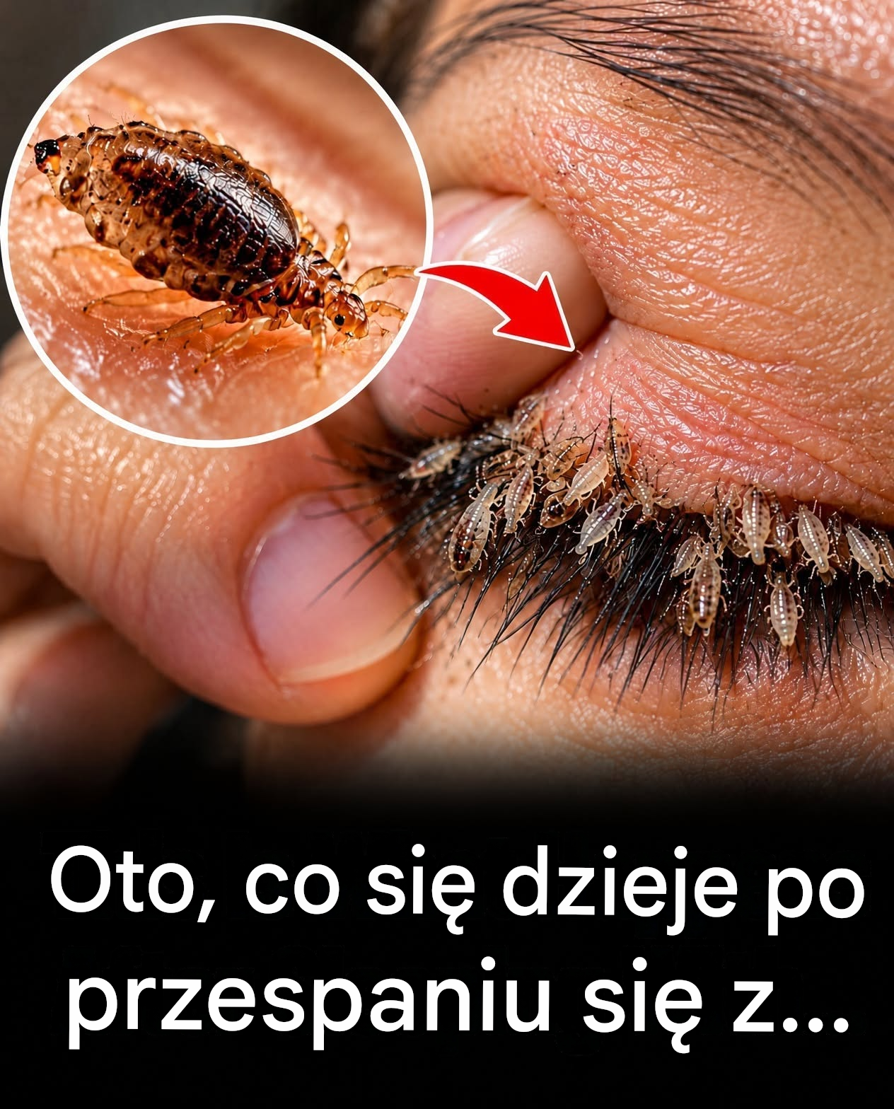 Co może się stać po przespaniu się z kimś? Zrozumieć wszy łonowe i zdrowie intymne