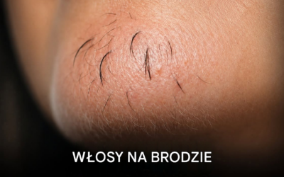 Eksperci twierdzą, że owłosienie na brodzie u kobiety może być oznaką czegoś więcej niż tylko starzenia się